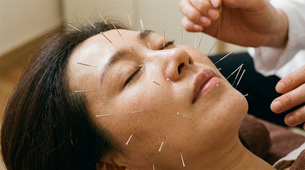 얼굴 침 치료 장면